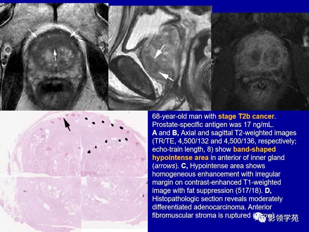 前列腺解剖及mri影像表现