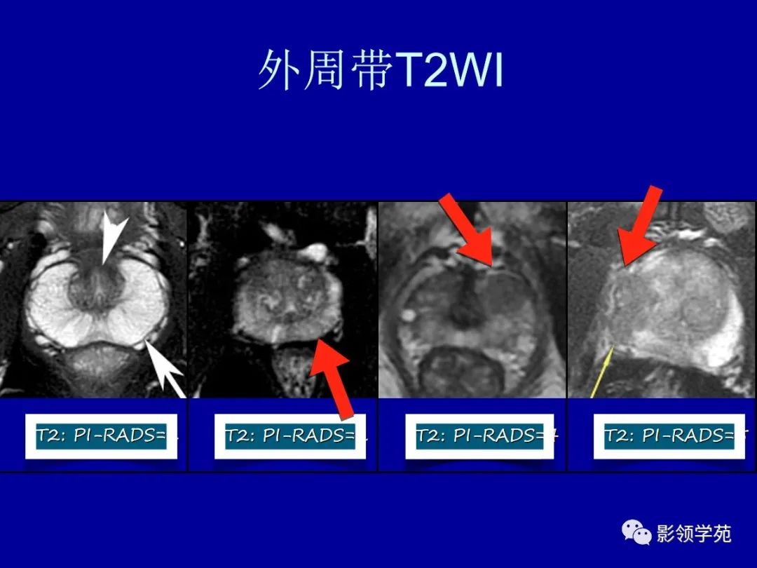 前列腺解剖及mri影像表现