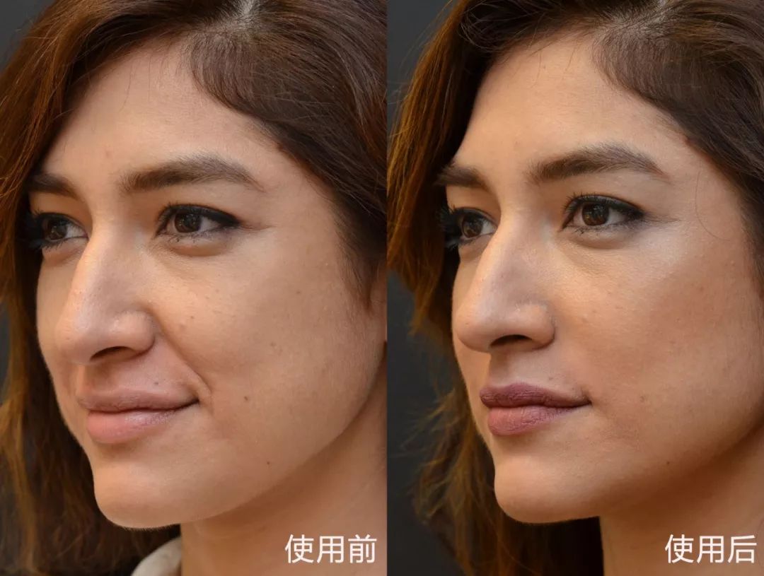 女人最怕三八纹教你一招不打针不手术7天赶走衰老法令纹