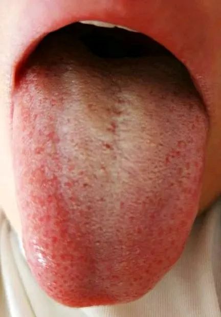 外寒内热的咳咳咳喘喘喘桂龙咳喘宁的用法