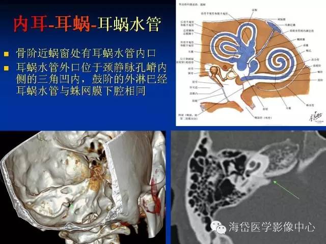 左心耳ct解剖结构图图片