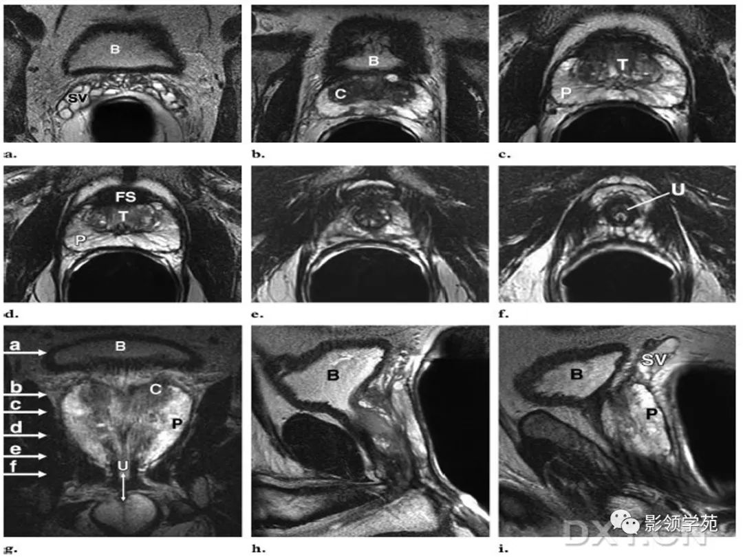 前列腺解剖及mri影像表现