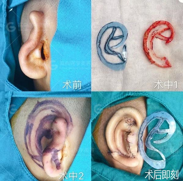 耳朵钙化图片图片