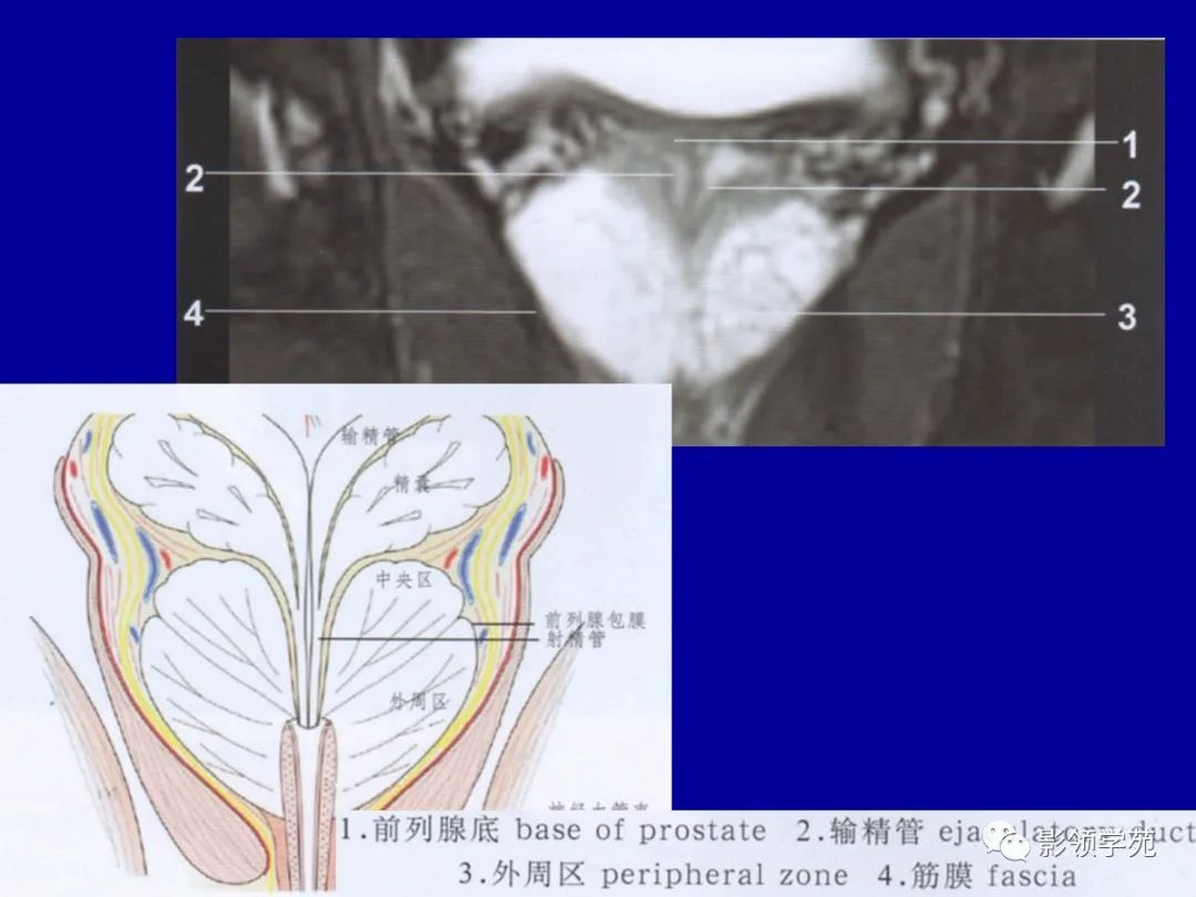 前列腺解剖及mri影像表现