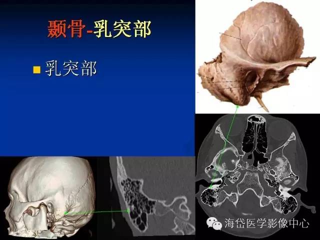 左心耳CT解剖图片