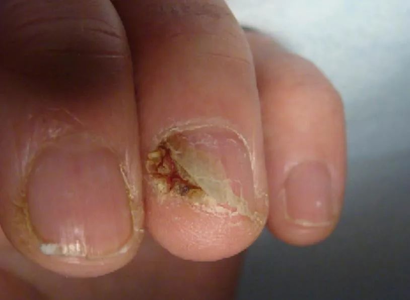 这10种指甲改变都不是甲真菌病千万别误诊