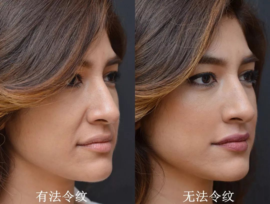 女人最怕三八纹教你一招不打针不手术7天赶走衰老法令纹