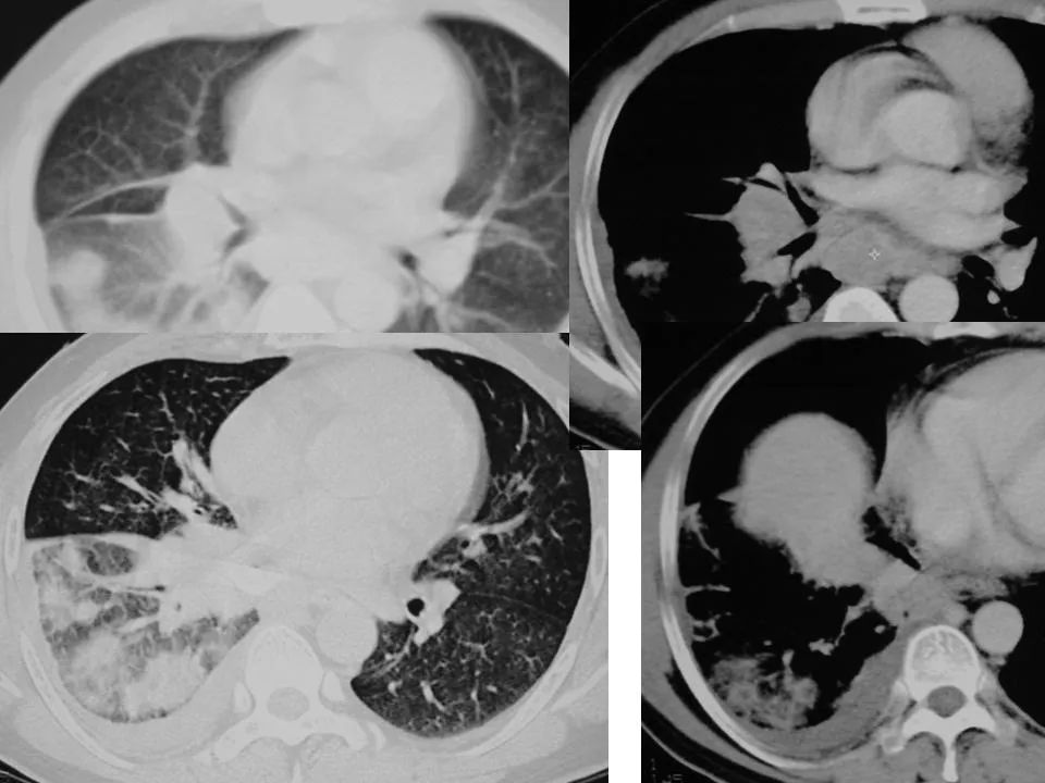 细支气管肺泡癌的影像学_李惠民