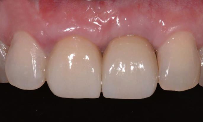 单颗前牙即刻种植即刻修复美学缺陷分析孙凤教授