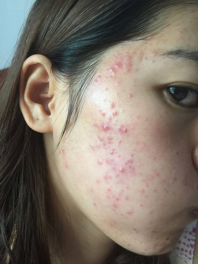为什么很多人抗痘多年，依旧为痘痘所困扰？她们到底哪里做错了？_皮肤
