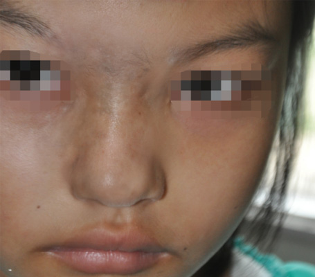 兽皮痣女儿差点做了植皮手术幸好遇到了主任