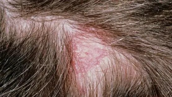 春天到头皮痒医生开的这个中西医治疗方帮你全搞定