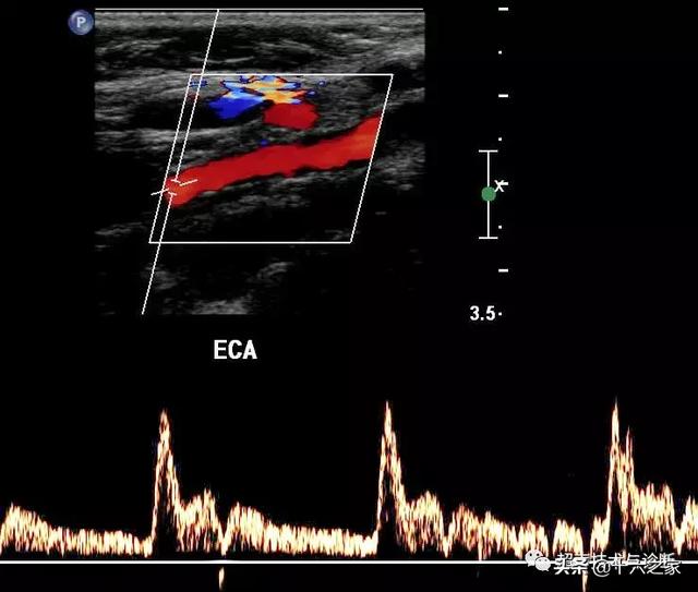血管超声超声如何辨别颈内动脉与颈外动脉
