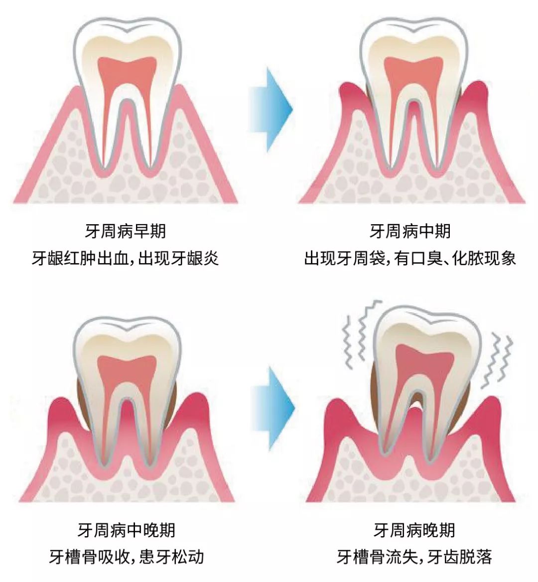 日本百年品牌專攻牙齦出血牙周病的極鹽牙膏舒緩清新口氣