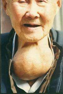 出现脖子增粗,颈前部有隆起肿块,首先应该想到是不是患上了甲状腺肿病