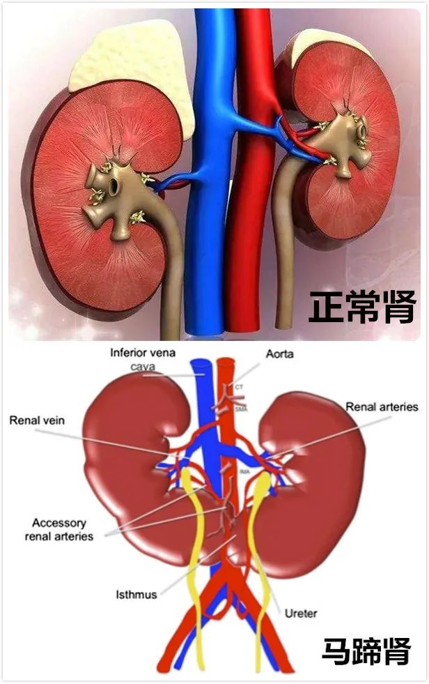 马蹄肾人均寿命肾积水图片