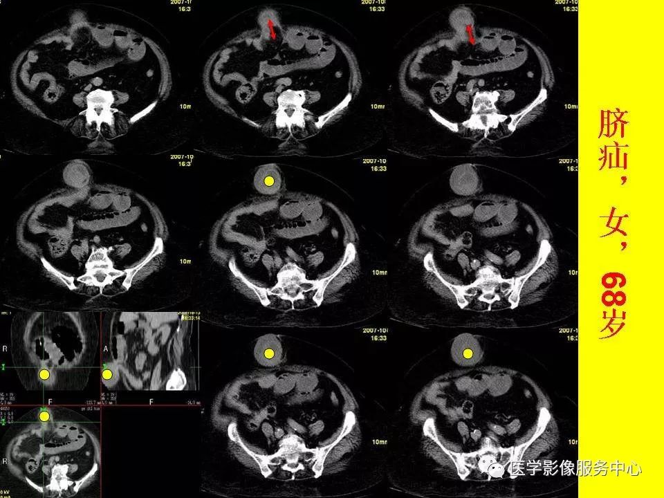 各种疝的ct影像诊断