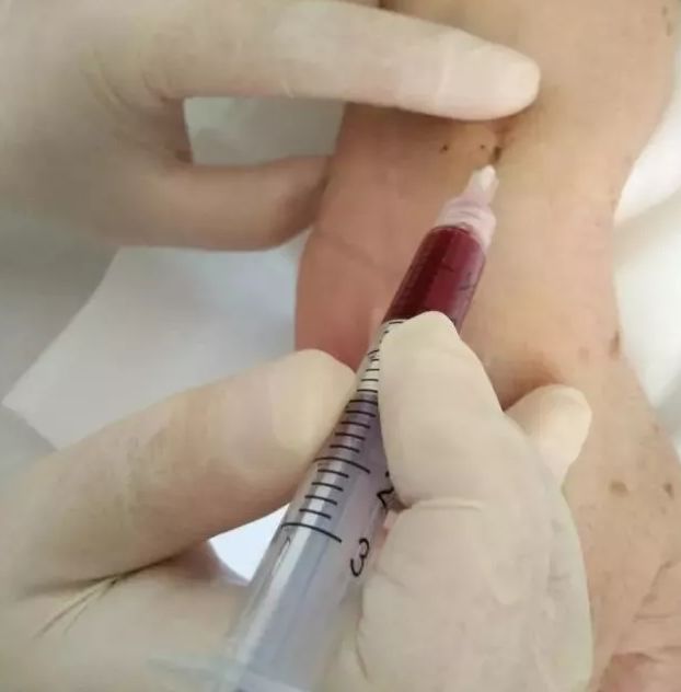 桡动脉采血时如何不错扎神经跟大内高手学这7步