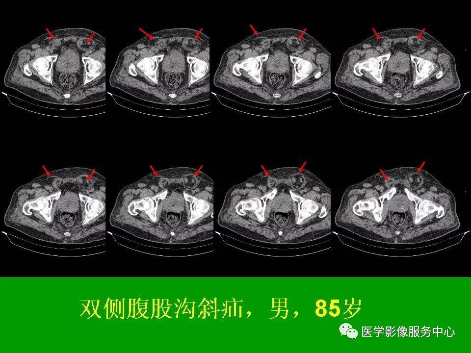 各种疝的ct影像诊断