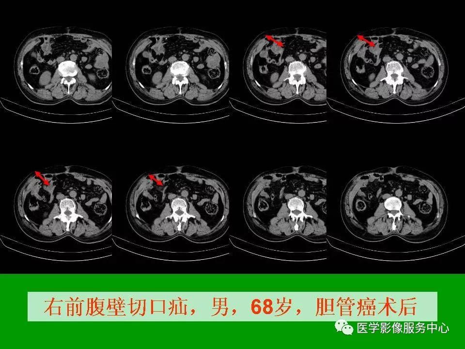 闭孔疝ct图片