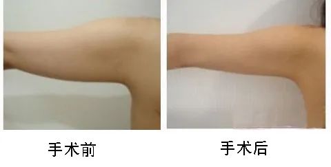 mdmp——无死角360°臂部吸脂术