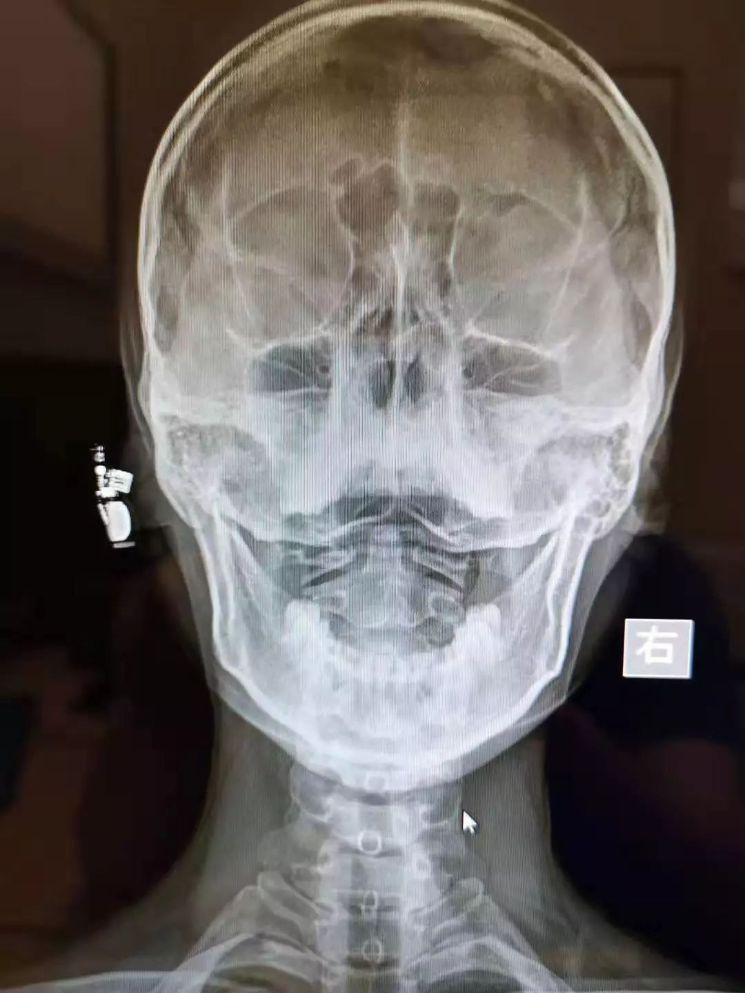 头颅正位x线解剖图图片