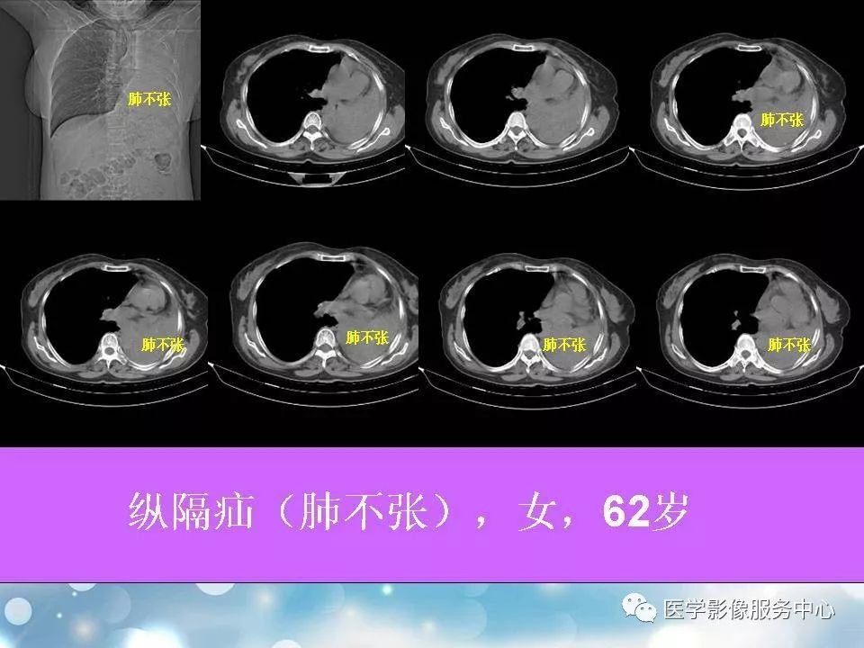各种疝的ct影像诊断