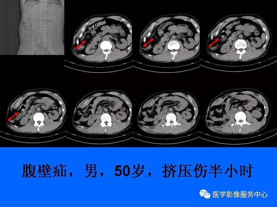 闭孔疝ct图片