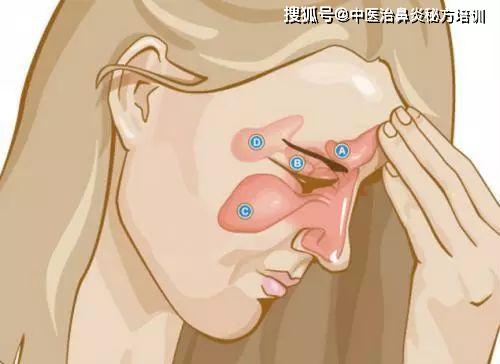 过敏或是感冒,都有可能诱发鼻窦炎,引发流鼻涕,头痛头晕,中耳炎,眉骨