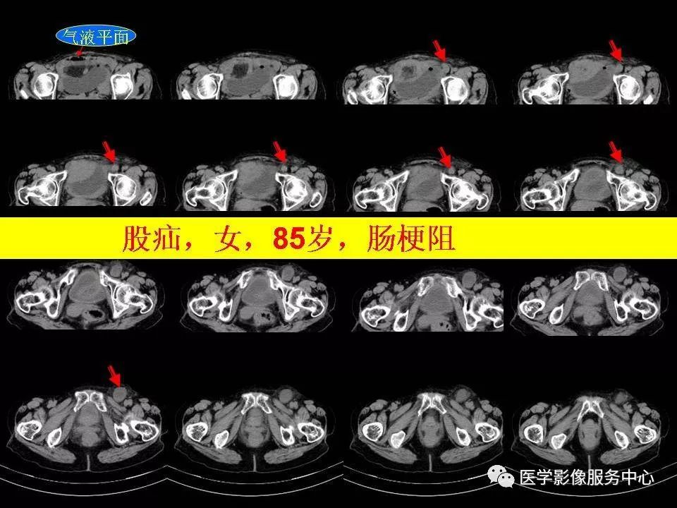 闭孔内肌CT图片