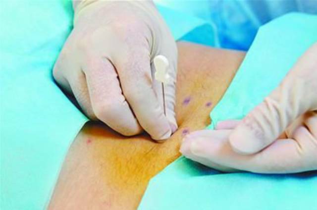 医疗特色微创针刀疗法