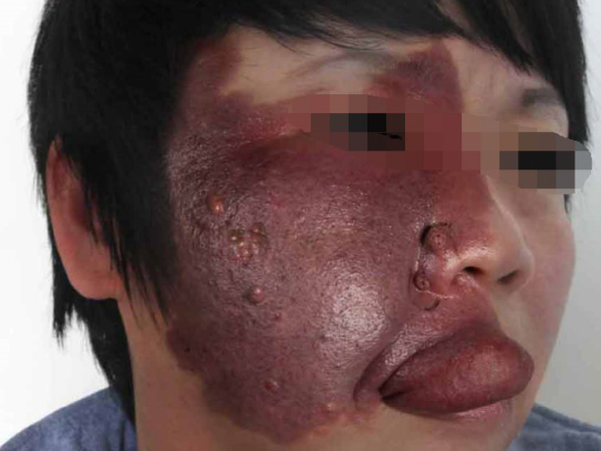 红胎记"绕圈子"四十年,其实与治愈只隔着一张纸!