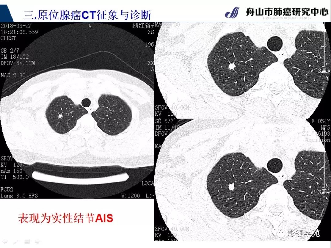 经典早期肺腺癌之肺原位腺癌ct表现