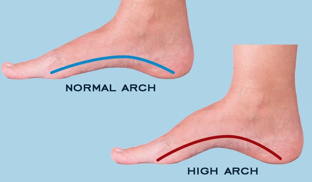 跖痛症?找到原因是关键--河南安阳足脊矫形中心帮您解决各种足部问题