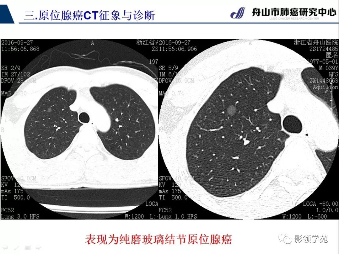 早期肺癌ct图 图解图片