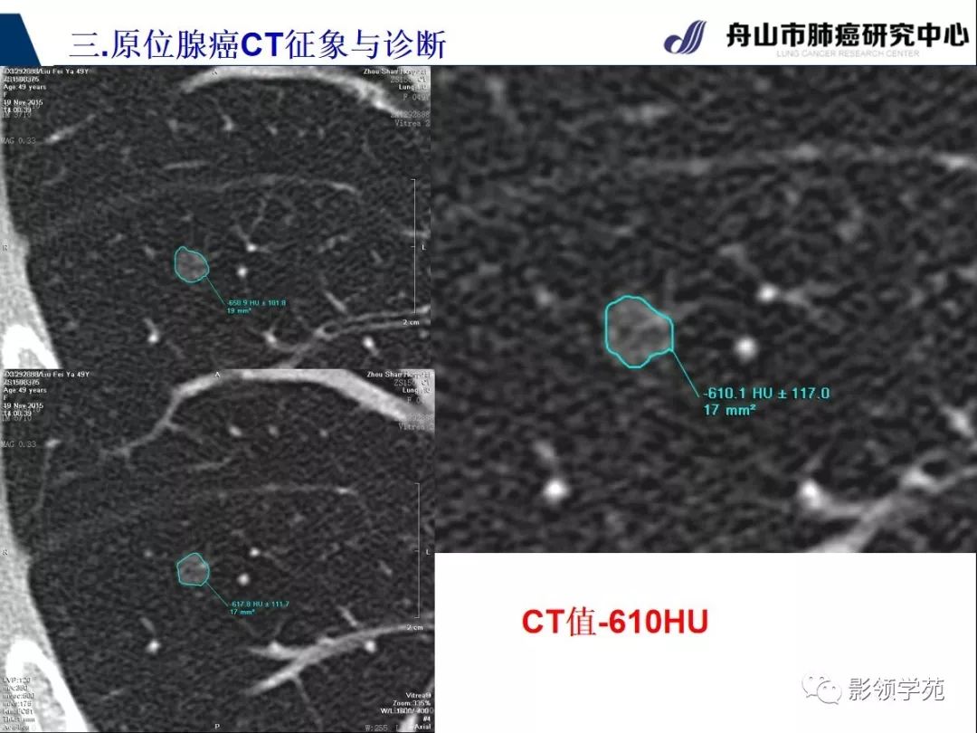 原位癌CT图片