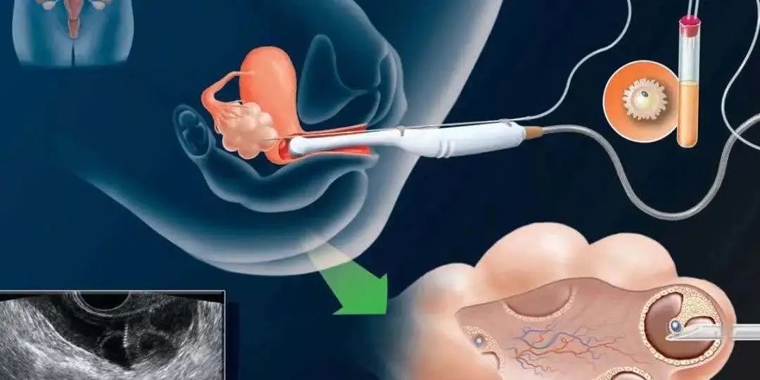 取卵是试管婴儿环节中重要的一步,在阴道b超引导下由穿刺针穿过阴道