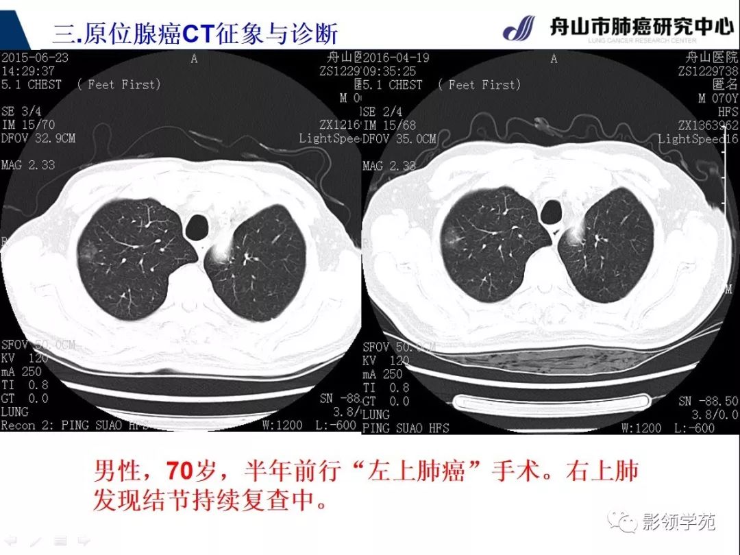 經典早期肺腺癌之肺原位腺癌ct表現