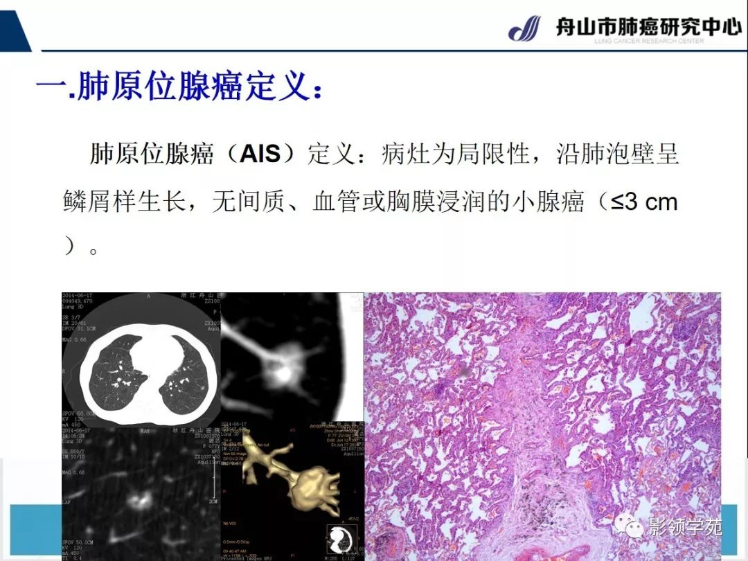 經典早期肺腺癌之肺原位腺癌ct表現