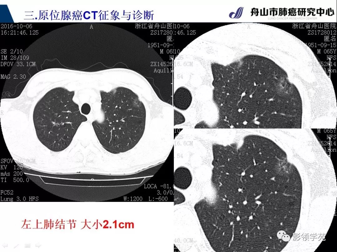 早期肺癌ct图图解影像图片