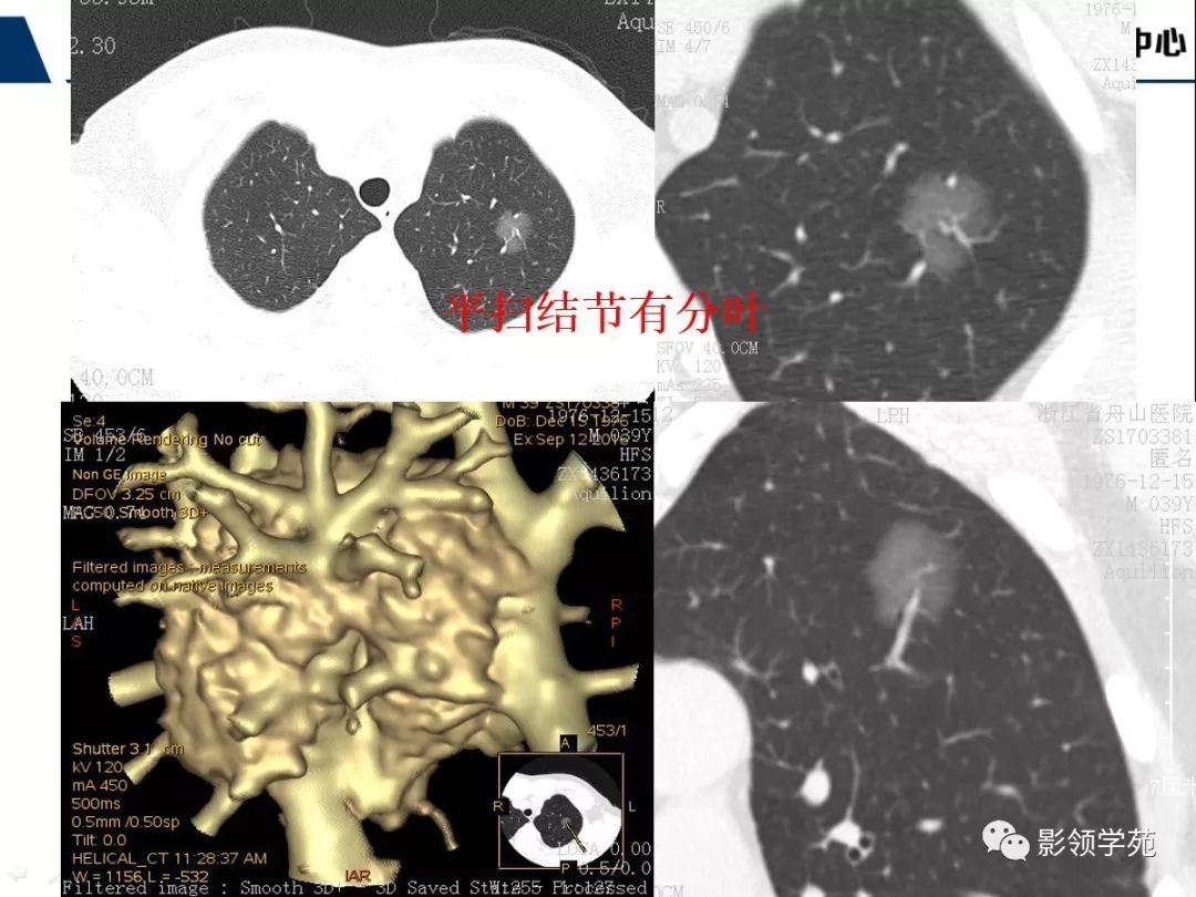经典早期肺腺癌之肺原位腺癌ct表现