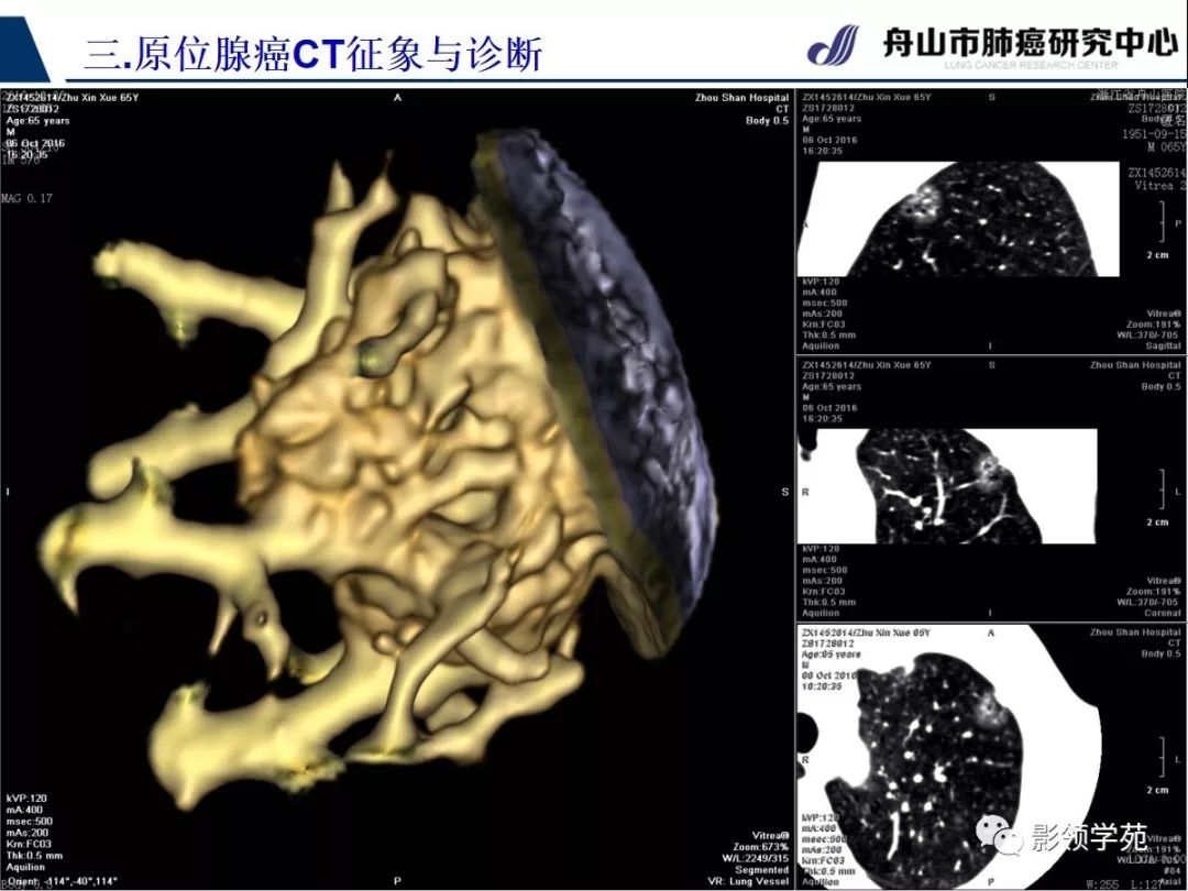 经典早期肺腺癌之肺原位腺癌ct表现