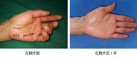 经常手麻的人需注意,这有可能是患上了腕管综合征