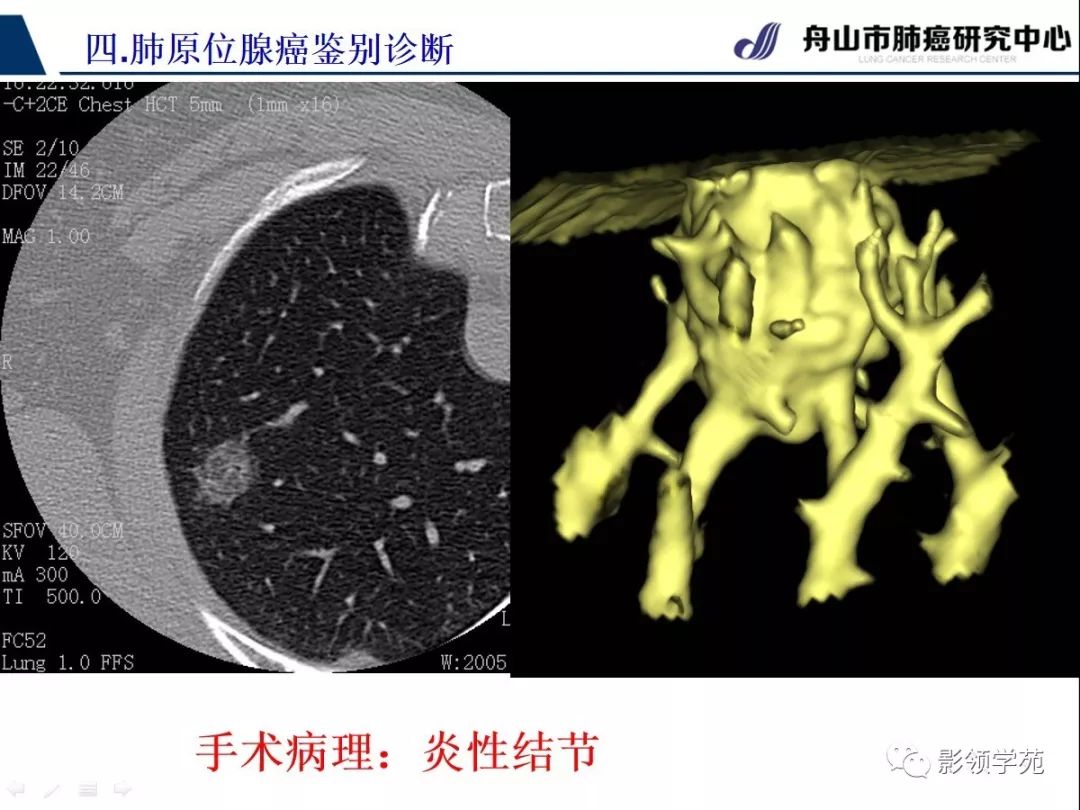 原位癌CT图片