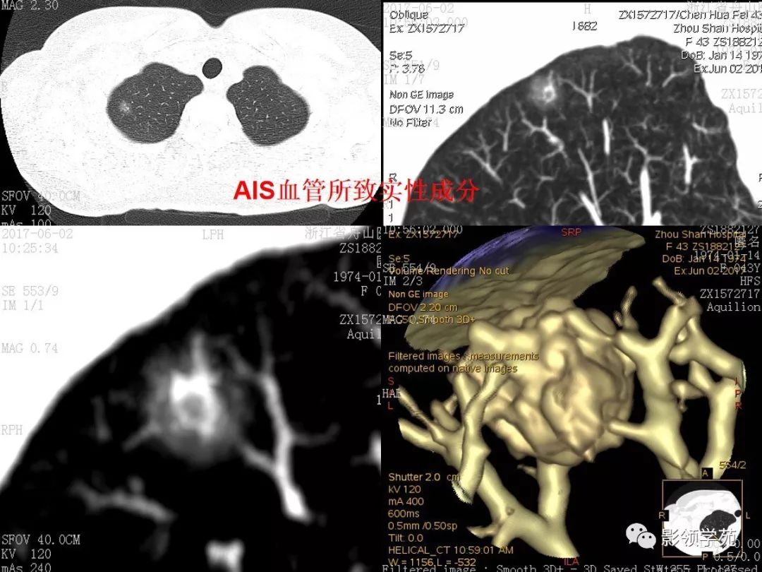 经典早期肺腺癌之肺原位腺癌ct表现