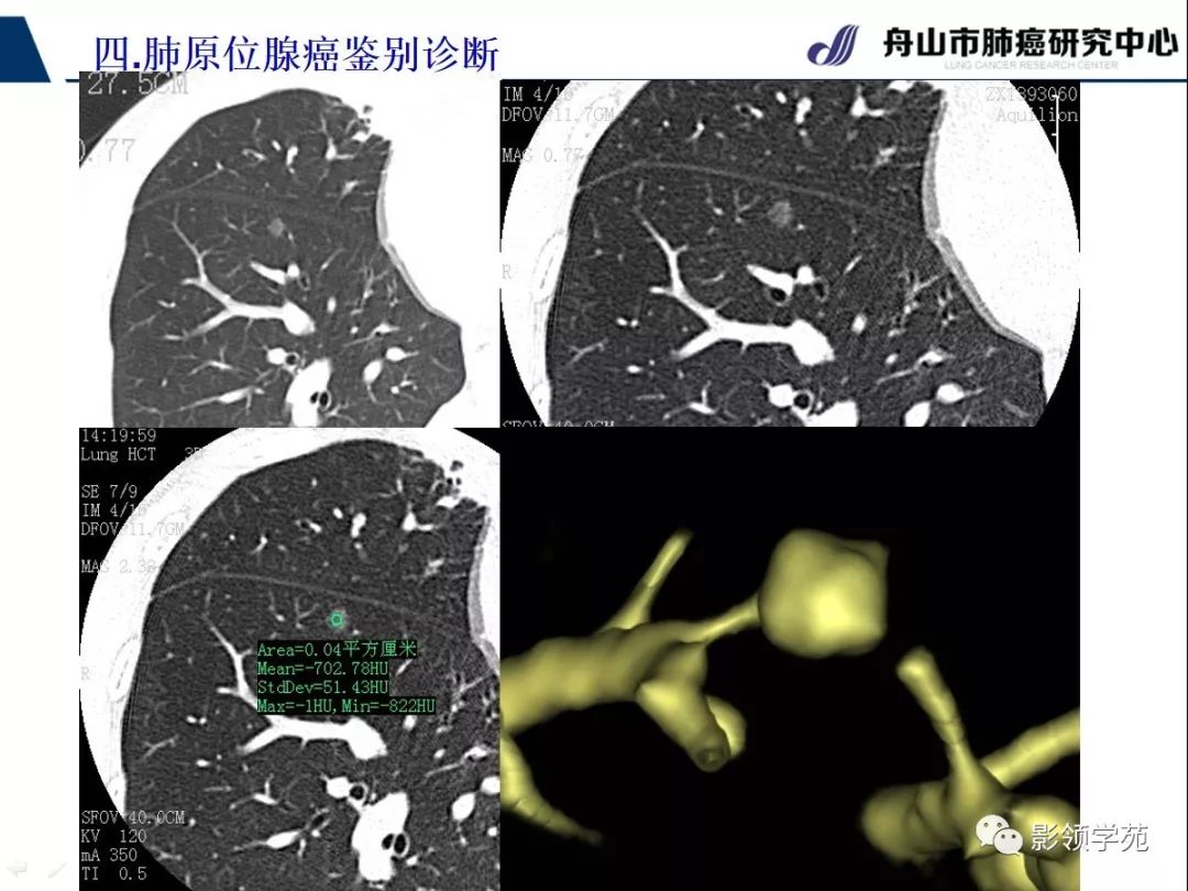 肺腺癌早期周圍型肺鱗癌ct診斷1早期周圍型肺鱗癌ct診斷2影領學院app