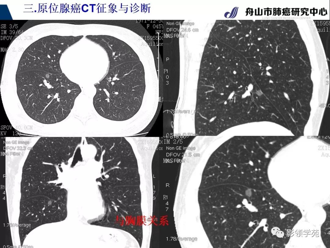 【经典】早期肺腺癌之肺原位腺癌ct表现
