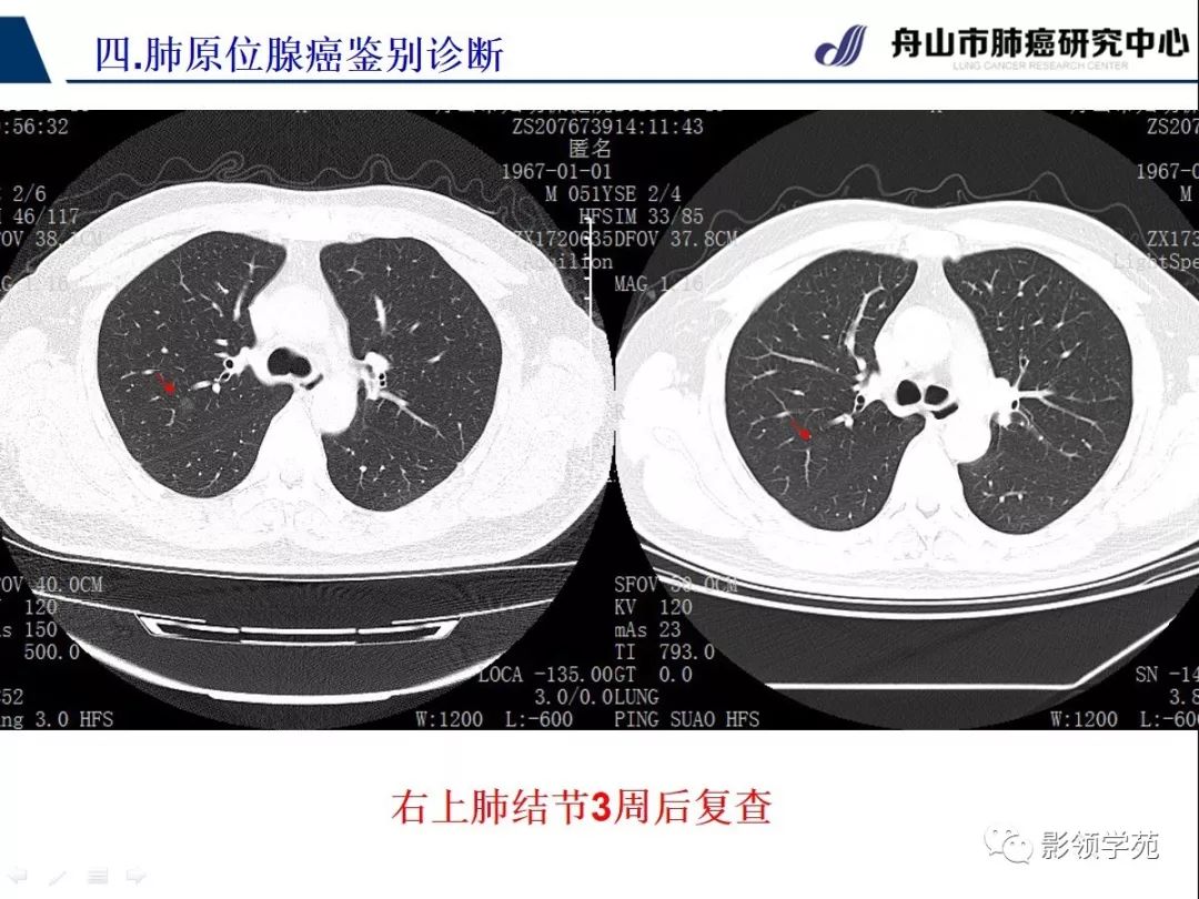 原位癌CT图片