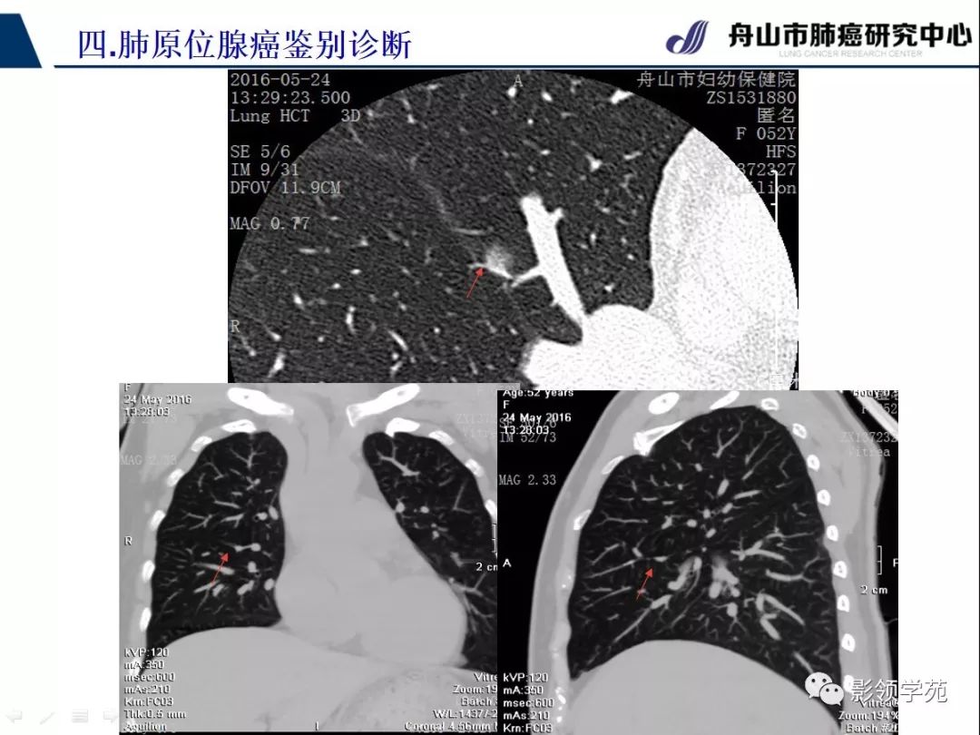 肺原位癌图片图片