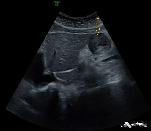 超声提示:胃窦增厚,考虑占位.